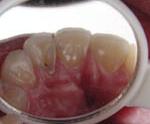 乳歯の虫歯チェック