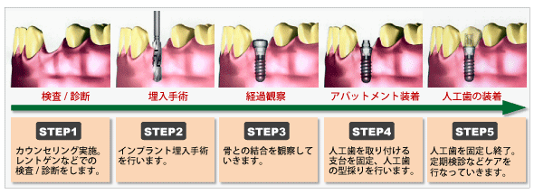 インプラント治療のながれ