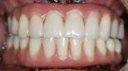 仮歯装着後