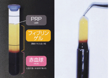 成分高濃度の血小板