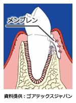 GTR（誘導組織再生）法